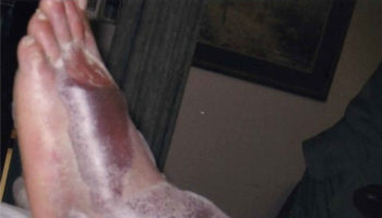 fracture blister