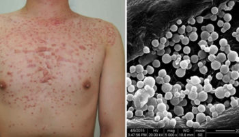 fungal folliculitis