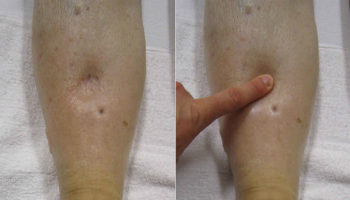 heat edema