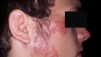 herpes gladiatorum