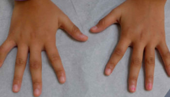 juvenile idiopathic arthritis