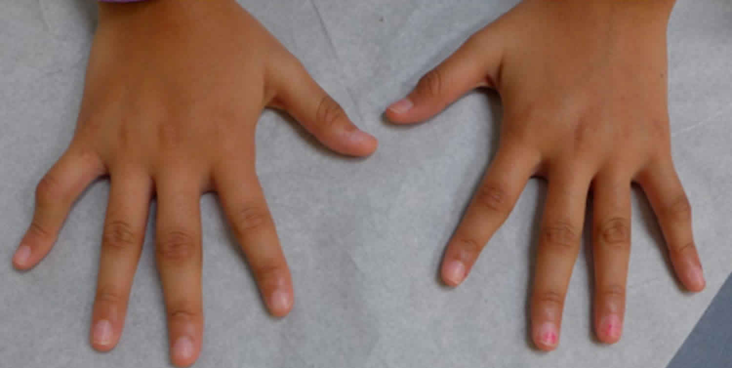 Juvenile Idiopathic Arthritis Causes Symptoms Diagnosis Treatment 