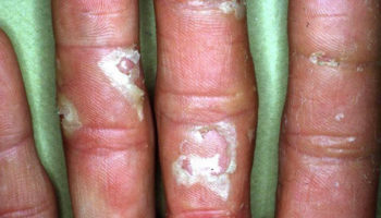 keratolysis exfoliativa