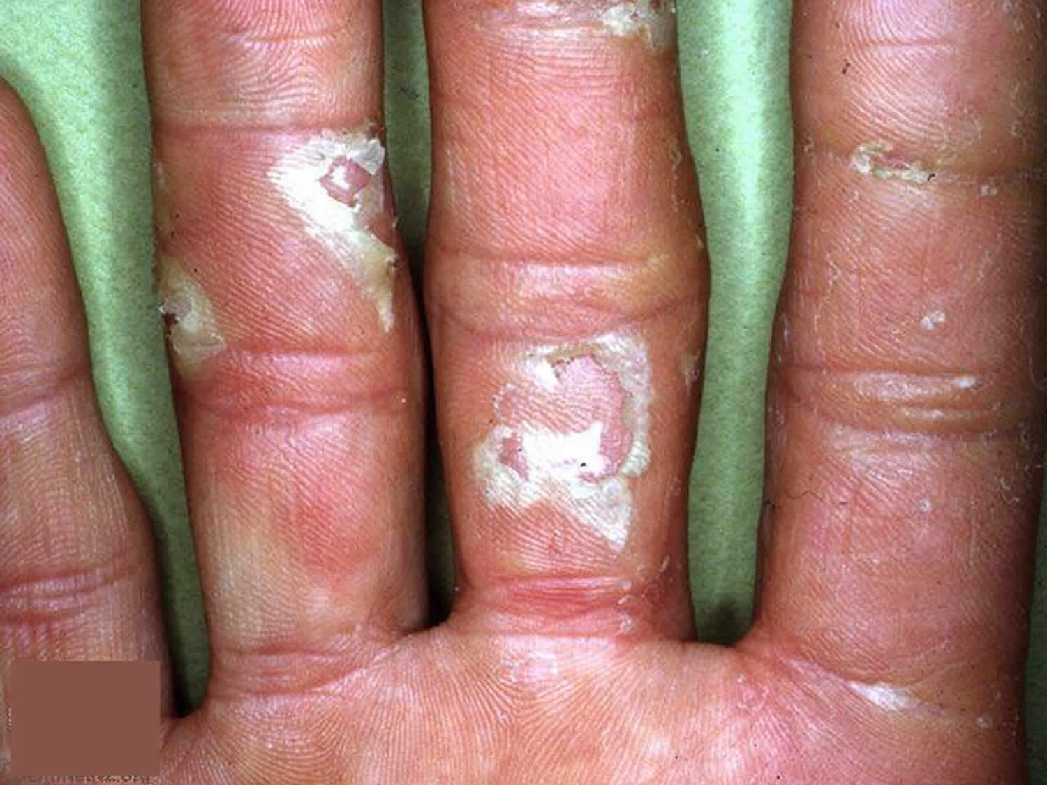 What Can Cause The Skin On Your Hands To Peel