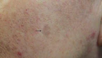 lichenoid keratosis