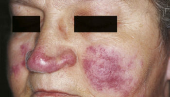 lupus pernio