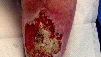 marjolin ulcer