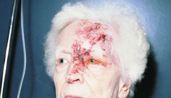 ophthalmic herpes zoster