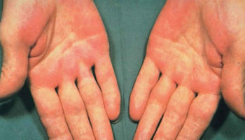 palmar erythema