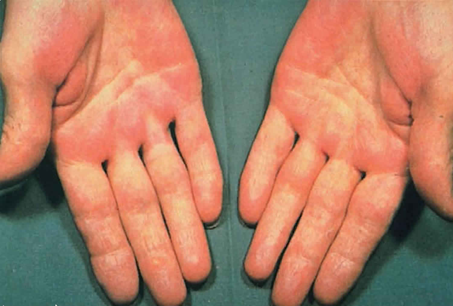 palmar-erythema-liver-disease