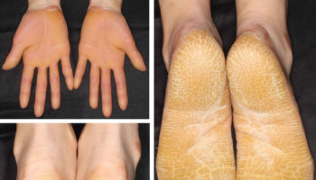 palmoplantar keratodermas