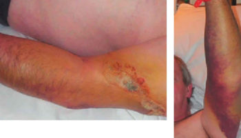 pasteurellosis