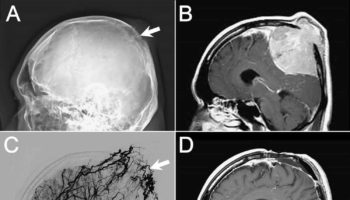 plasmacytoma