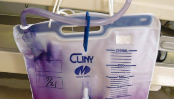 purple urine bag syndrome