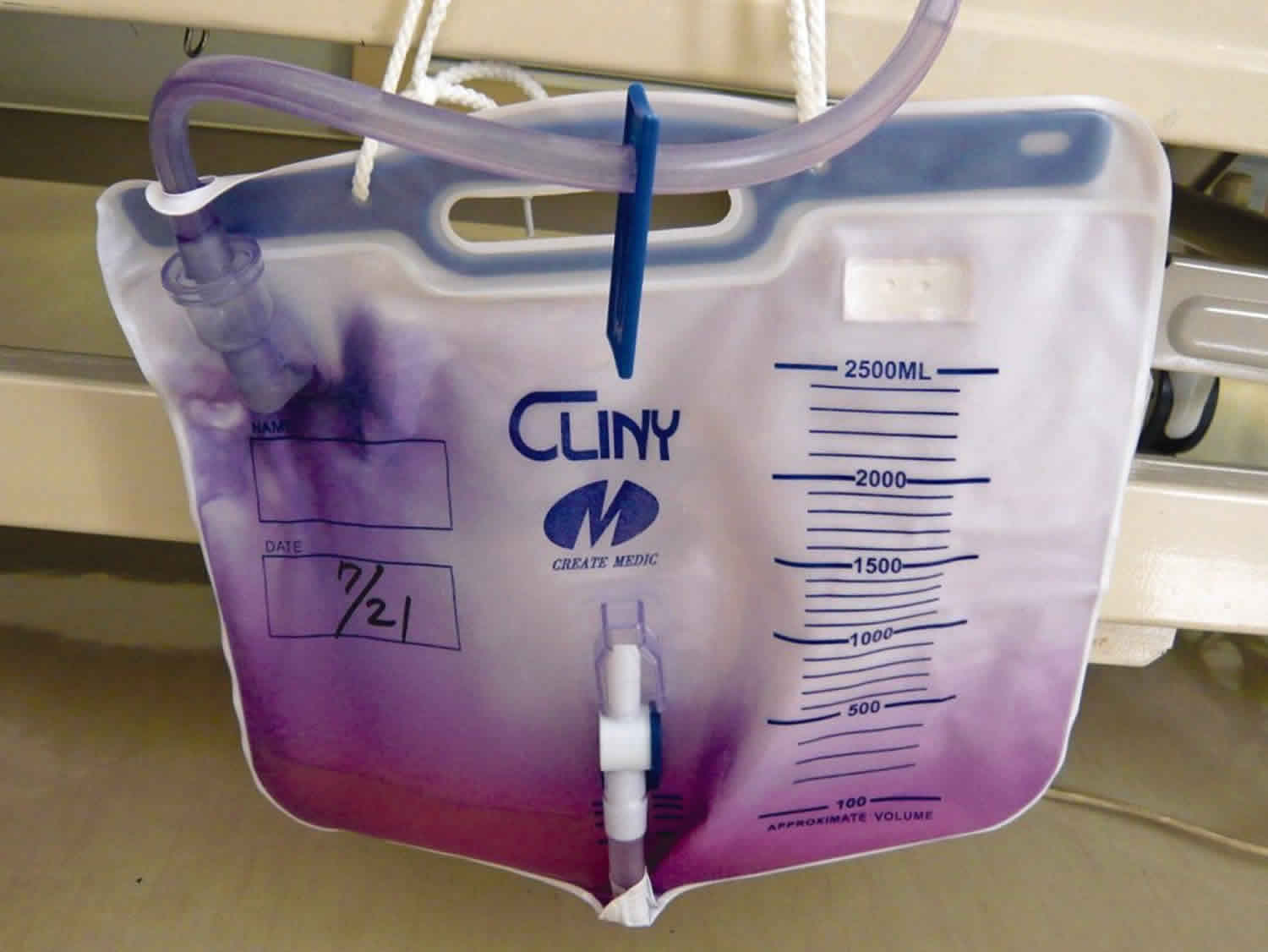 purple-urine-bag-syndrome-causes-symptoms-diagnosis-treatment