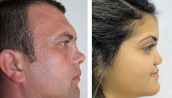 saddle nose