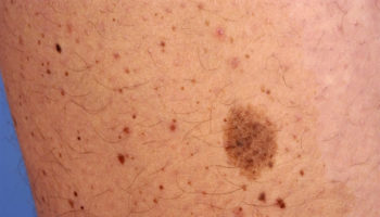 speckled lentiginous nevus