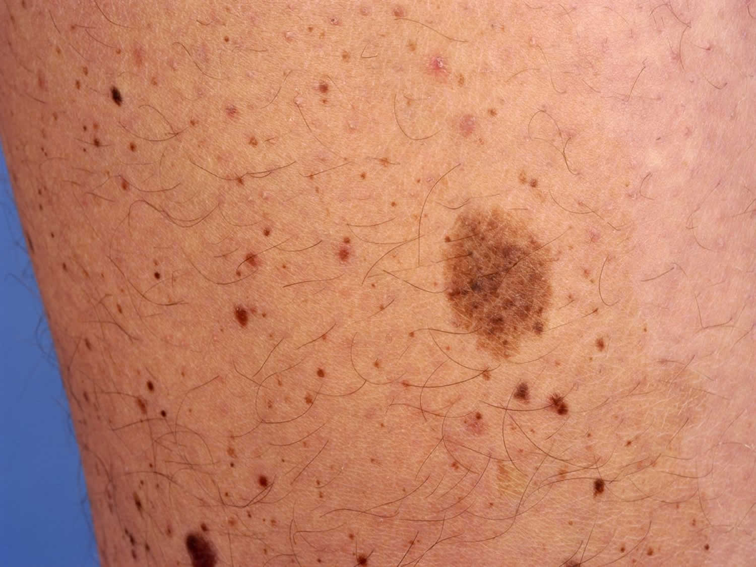 Nevus spilus causes, symptoms, diagnosis & treatment