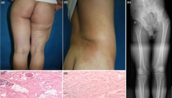 stiff skin syndrome