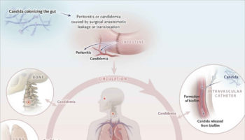 systemic candidiasis