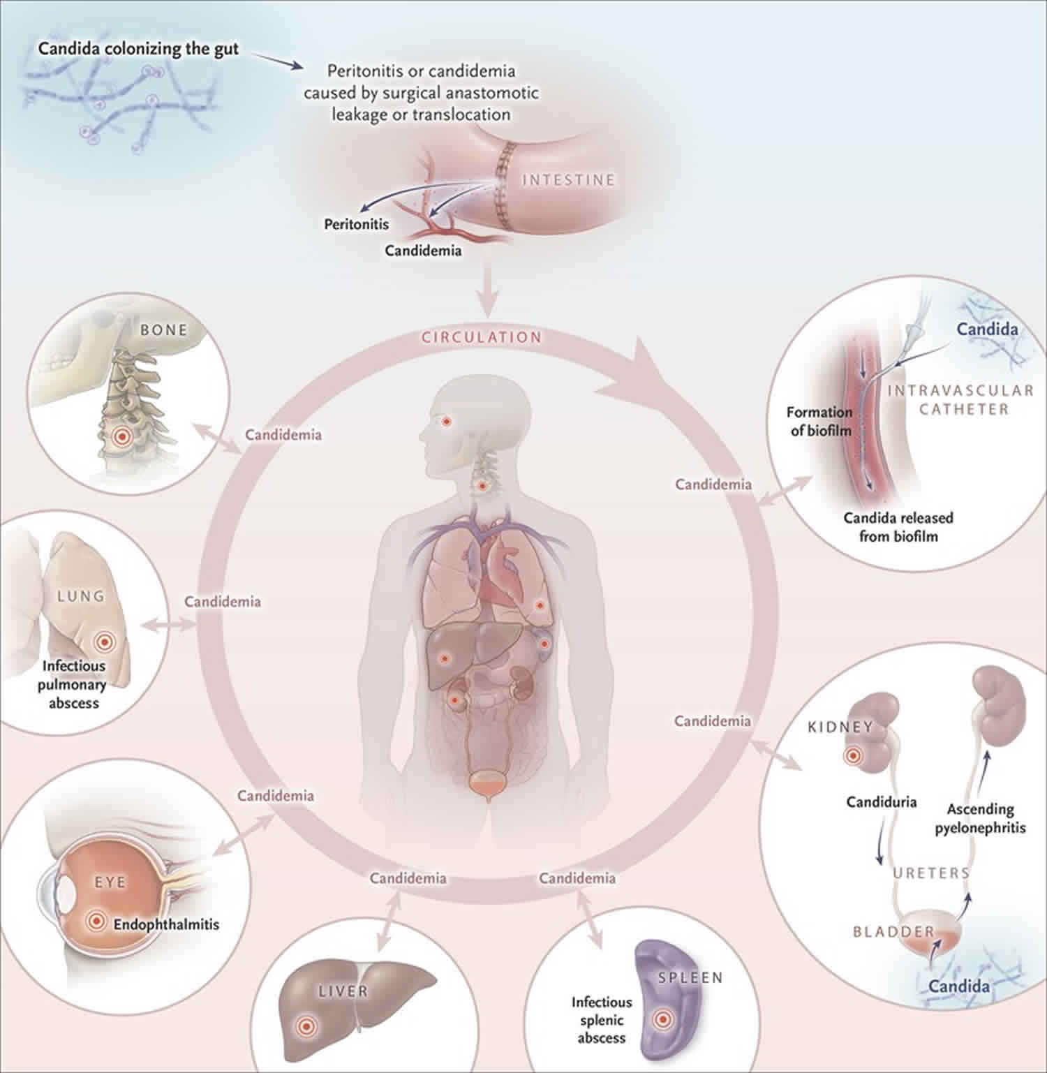 Systemic Candidiasis Causes Symptoms Diagnosis Treatment Prognosis