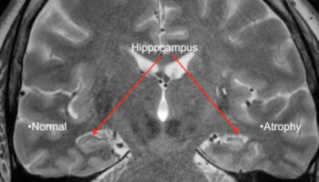 temporal-lobe-epilepsy