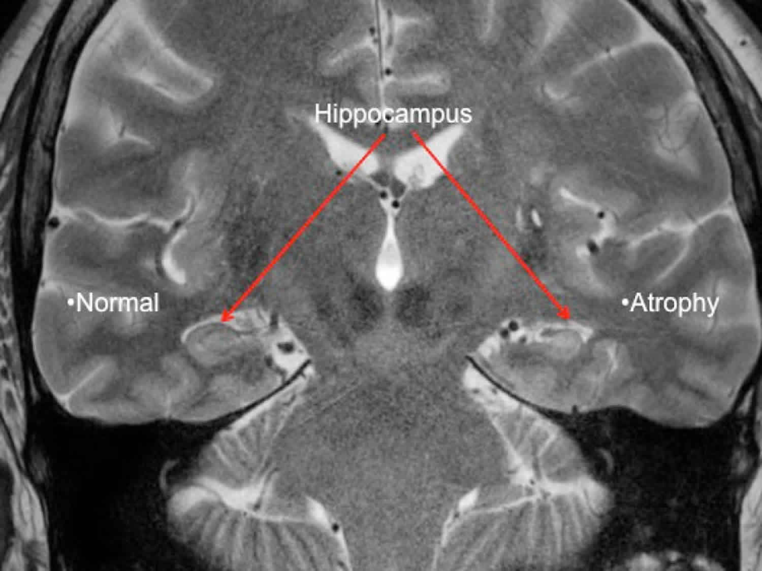 temporal-lobe-epilepsy