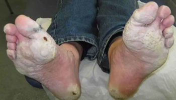 trench foot