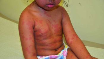 urticaria multiforme