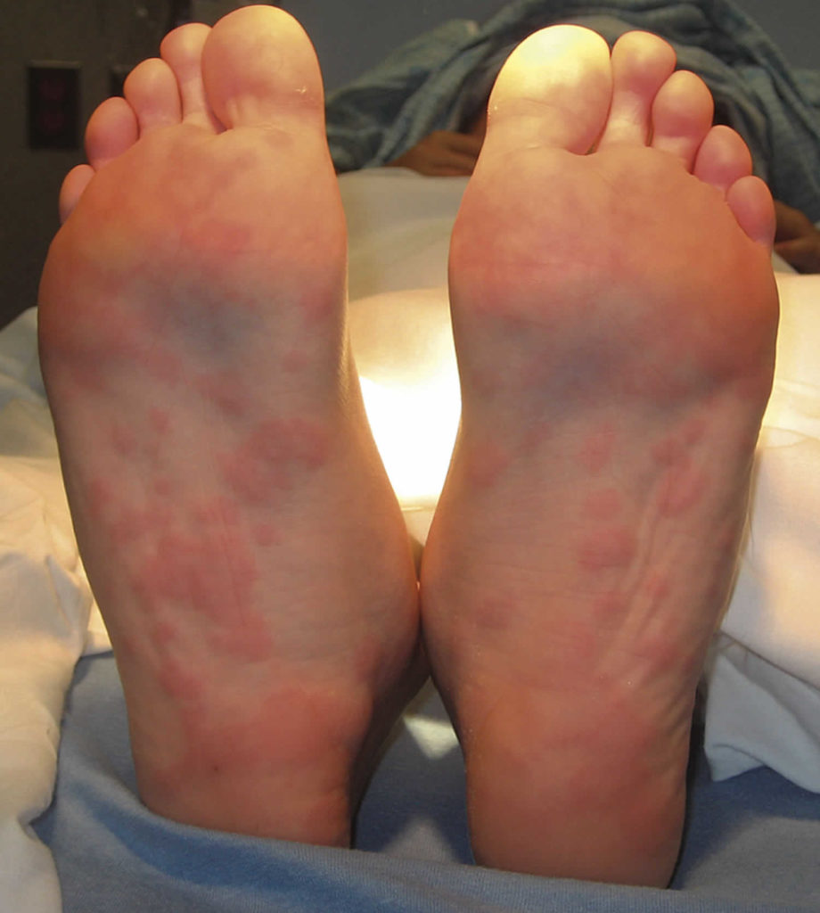 Urticaria multiforme causes, symptoms, diagnosis & treatment