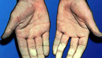 vibration white finger