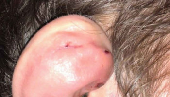 wrestlers ear