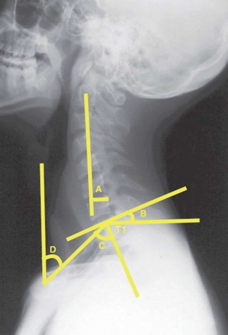 Cervical Kyphosis Preoperative Planning 768x1127 