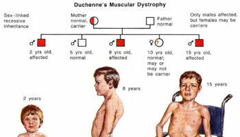 Duchenne-muscular-dystrophy