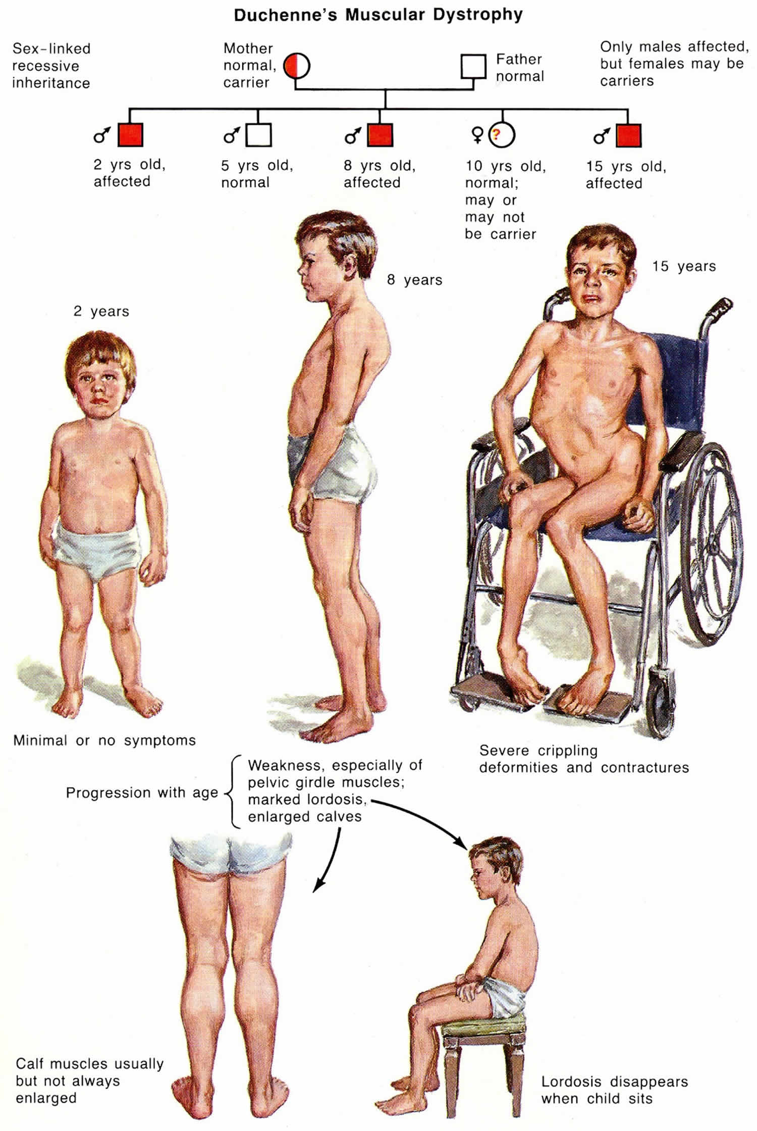 Duchenne Muscular Dystrophy Causes Symptoms Diagnosis Treatment 6408