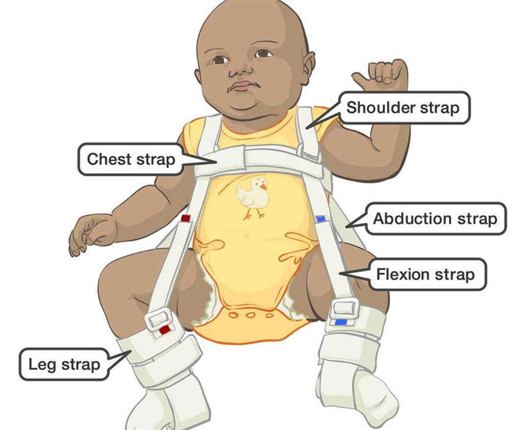 Developmental dysplasia of the hip causes, symptoms, diagnosis ...