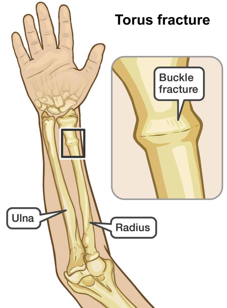symptoms of adult buckle fracture wrist