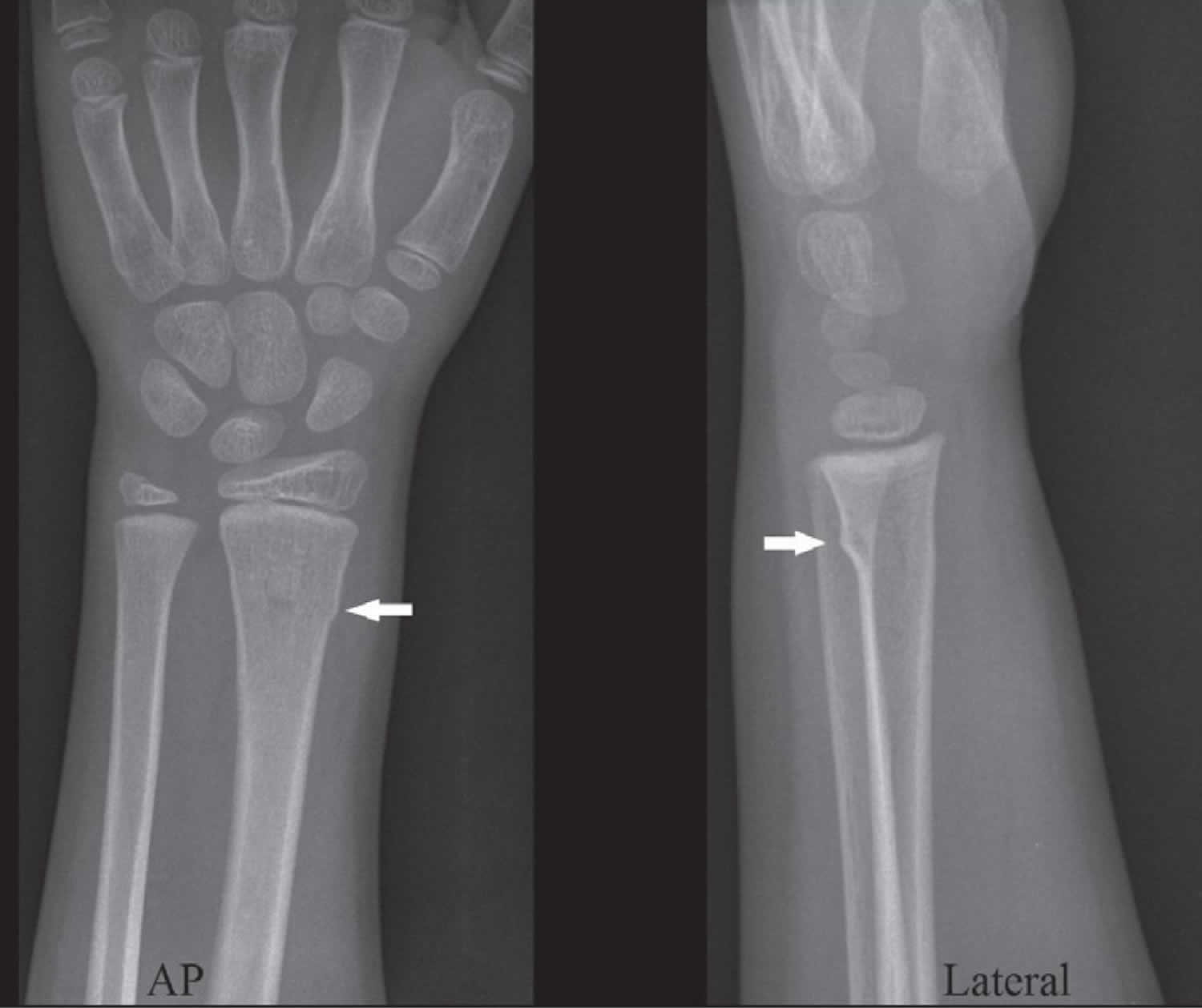 distal radius fracture splint type