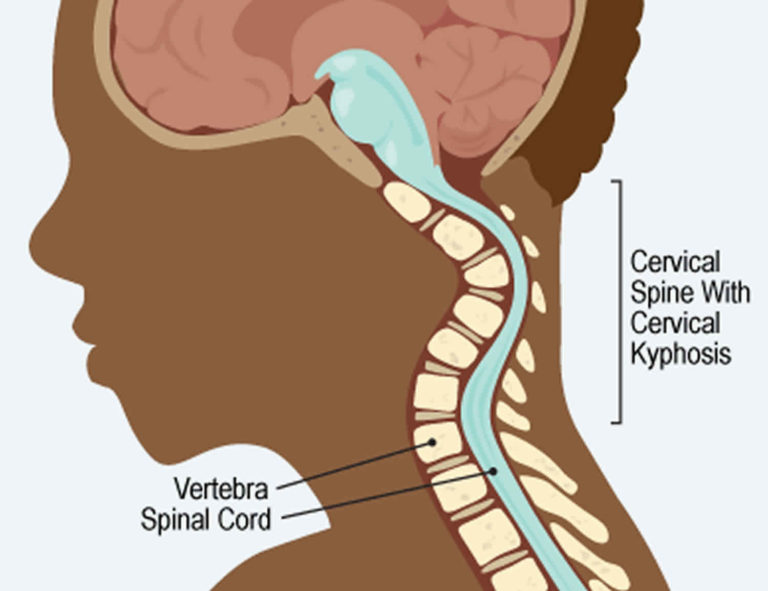Cervical kyphosis causes, symptoms, diagnosis & treatment