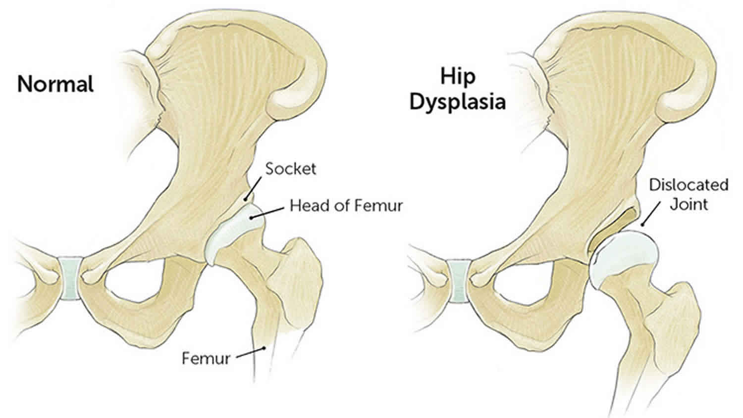 hip dysplasia normal hip xray