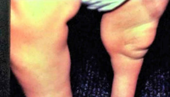 fibular-hemimelia