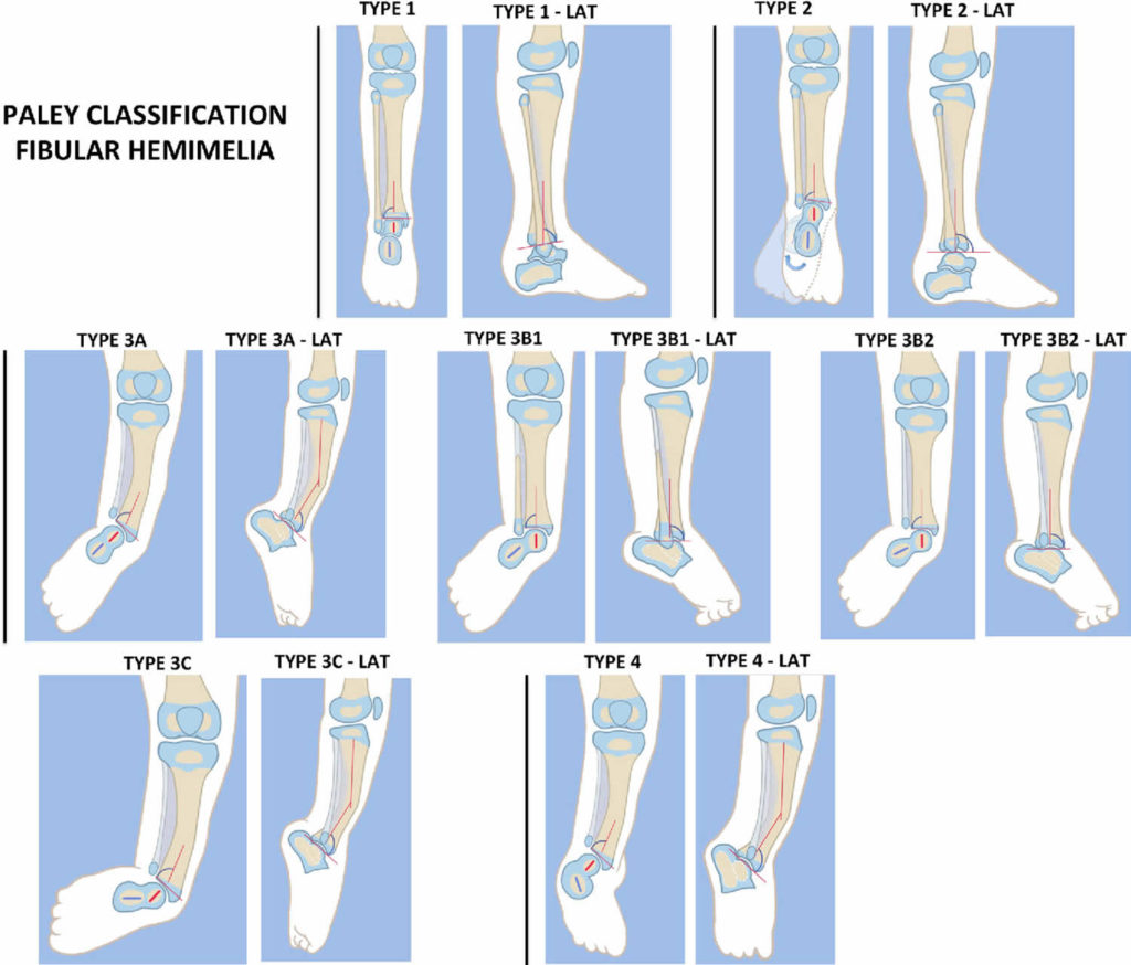 Fibular hemimelia causes, signs, symptoms, diagnosis & treatment