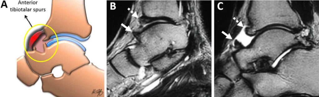 Ankle Impingement Syndrome Causes Symptoms Diagnosis And Treatment