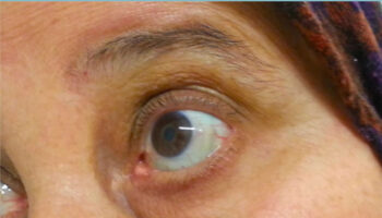Blue sclera