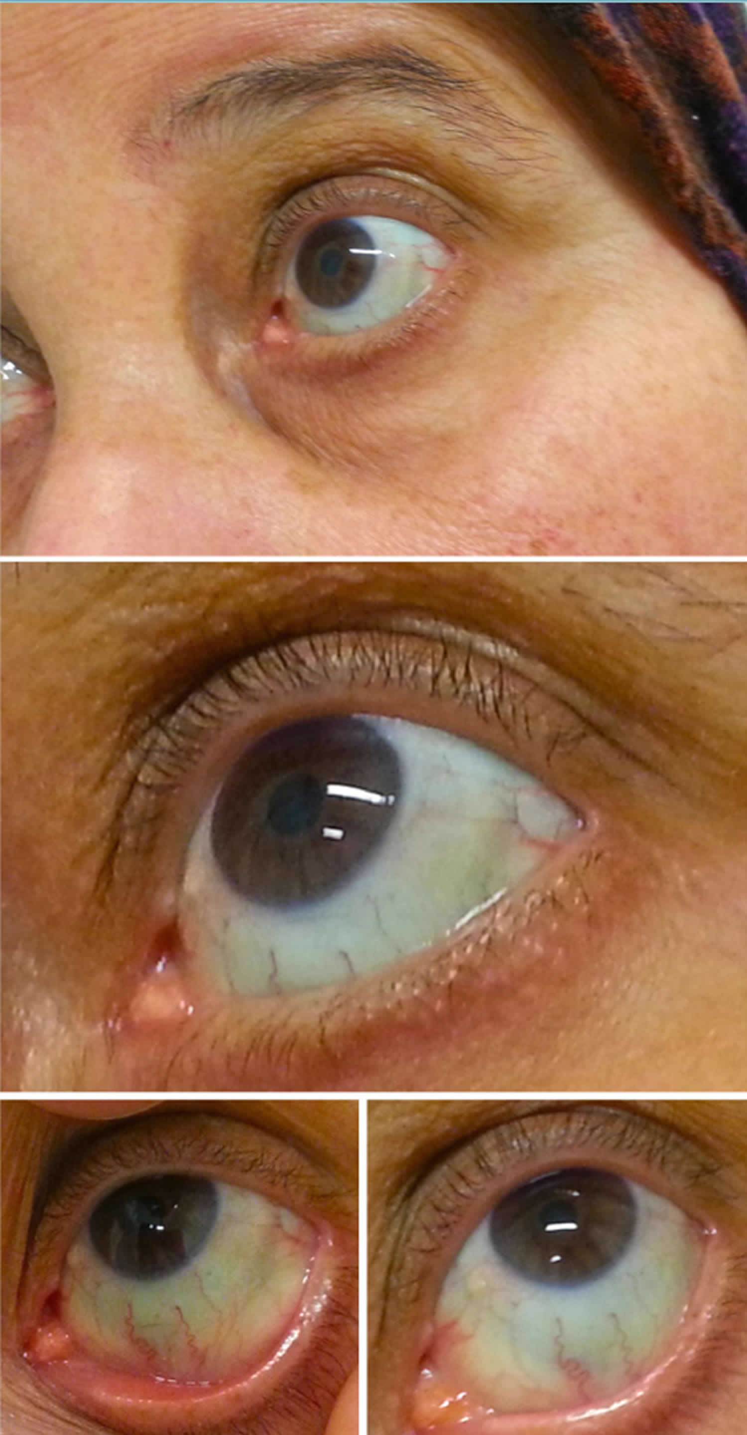 Blue Sclera Causes Symptoms Diagnosis Treatment And Prognosis 