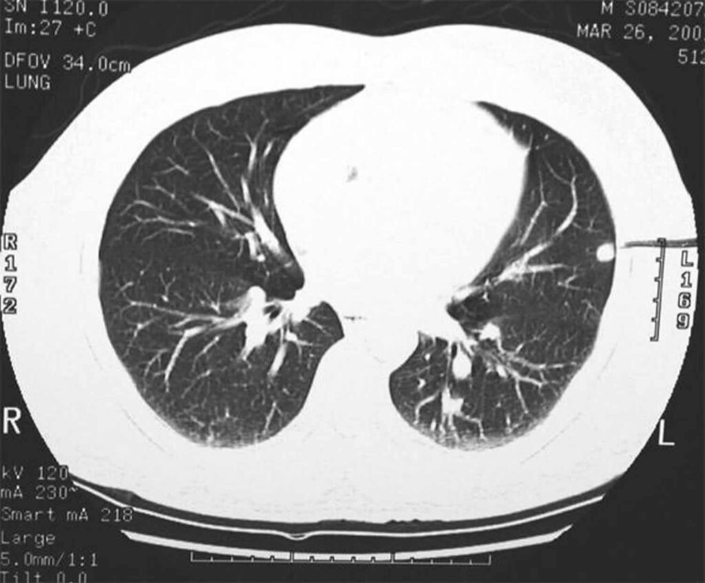 Granuloma Calcificado En Pulmon - REVOEDUCA