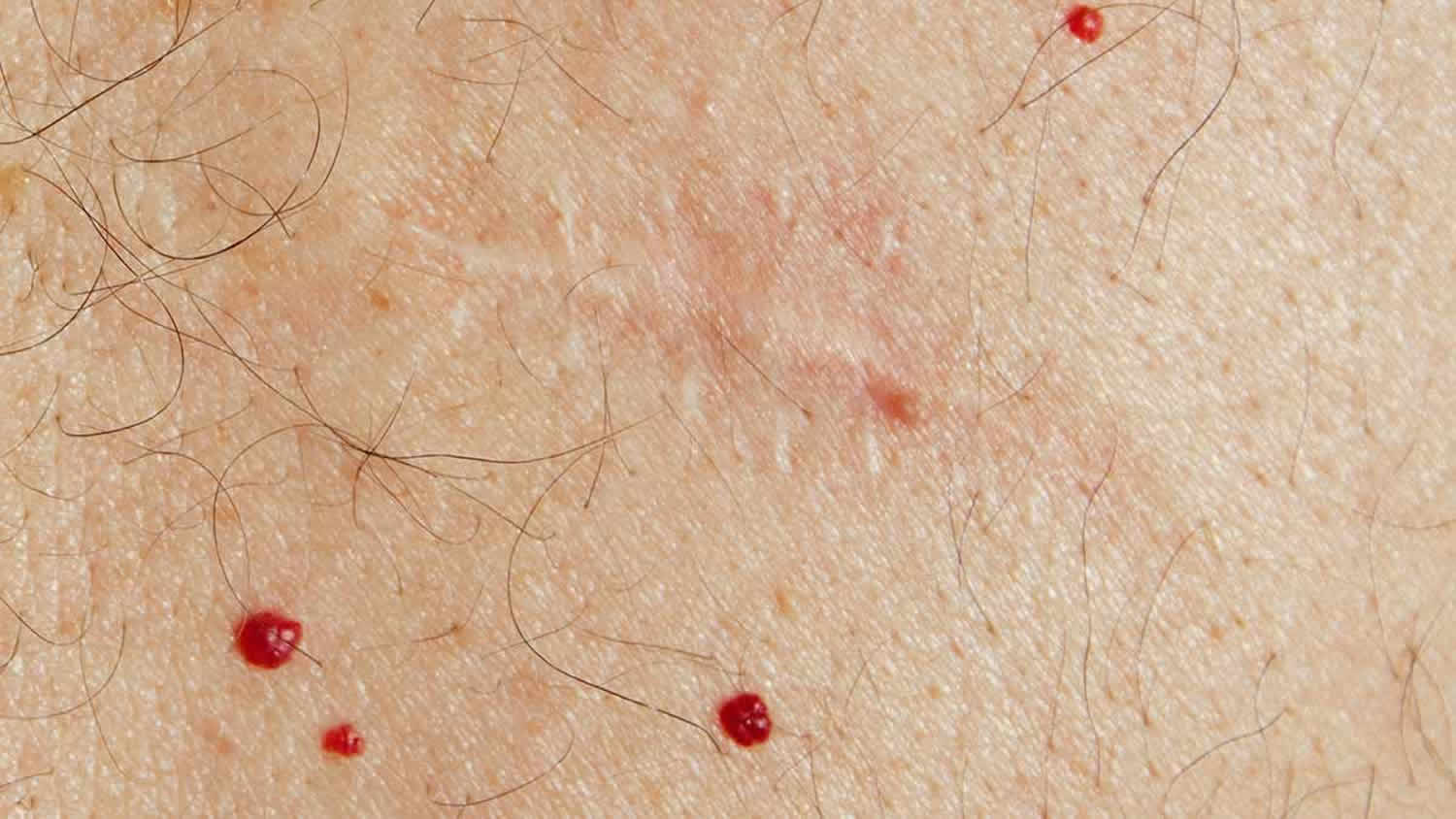 красные точки на груди у женщин фото 112