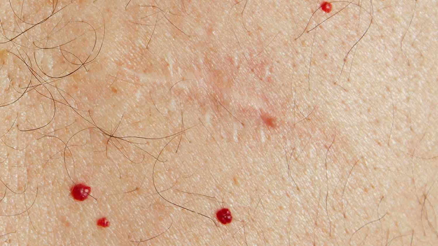 Cherry Angioma Causes And Treatment What Is A Cherry Angioma Causes 