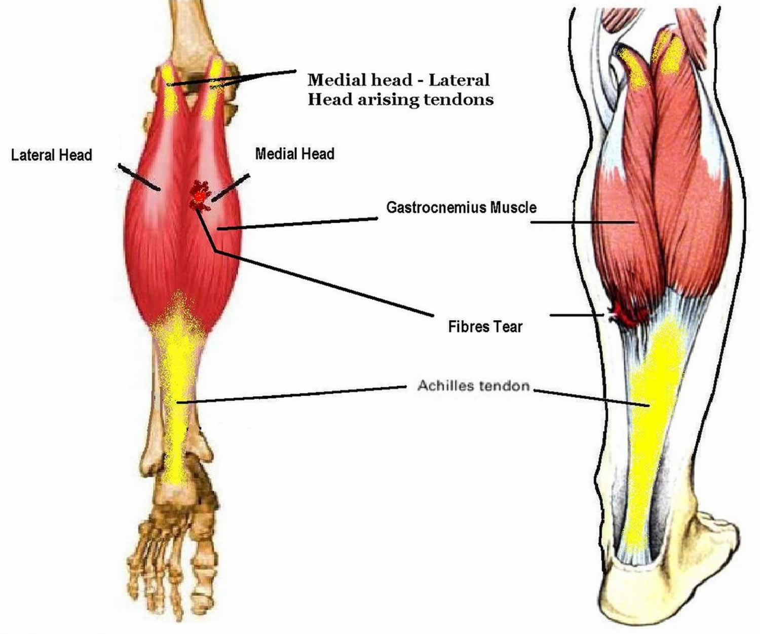 Medial Gastrocnemius Strain