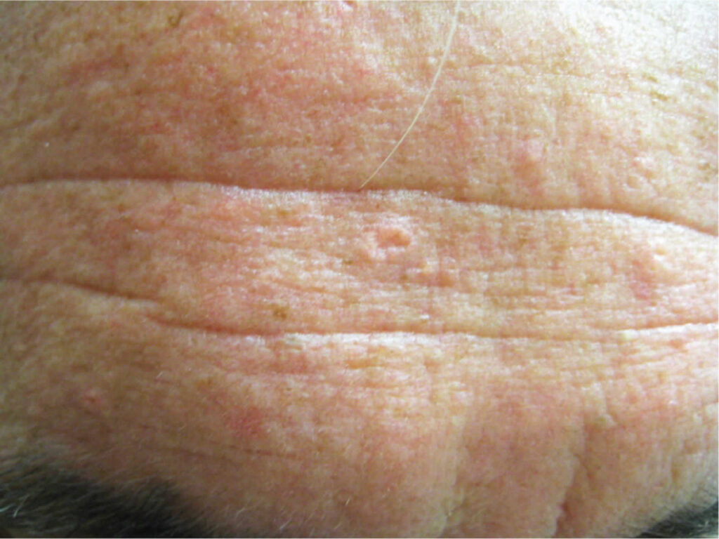 Benign Skin Lesions Definition Common Benign Skin Lesions Diagnosis ...